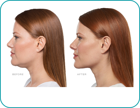 Kybella